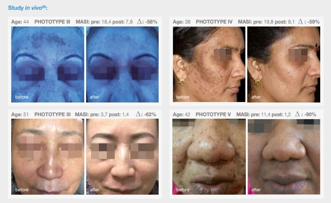 Cosmelan Skin Rejuvenation Treatment