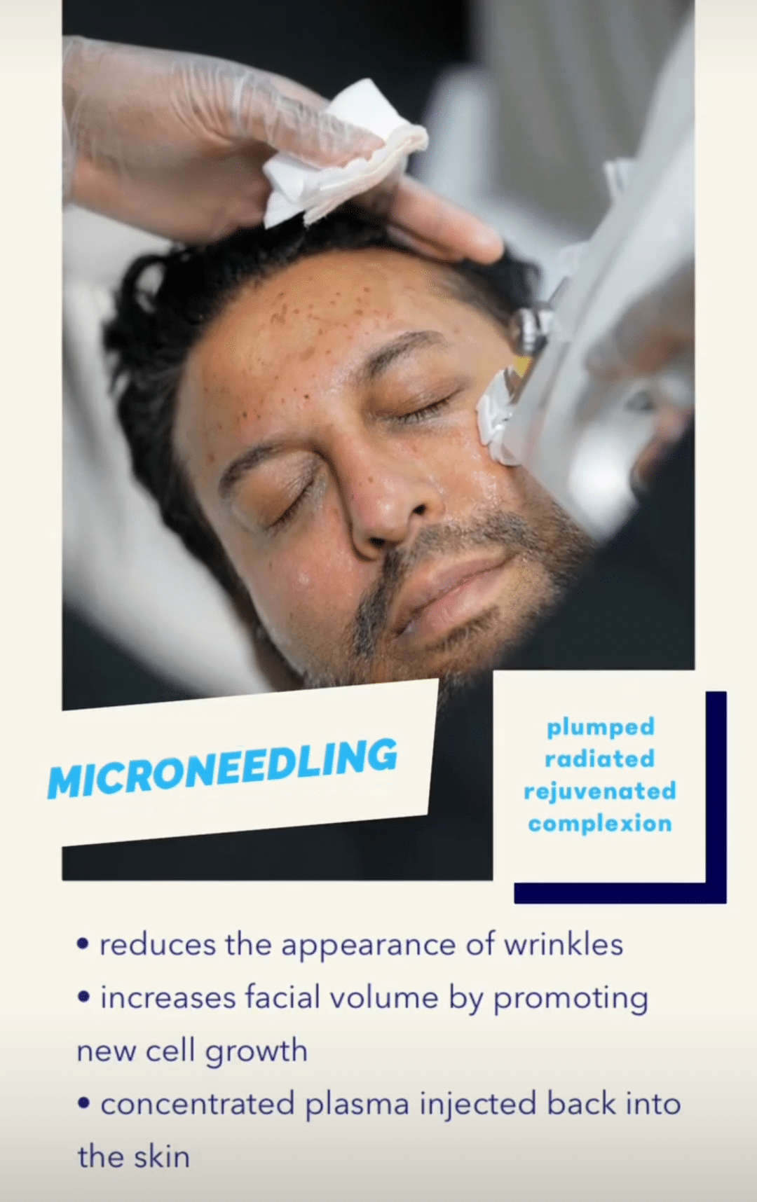 EPN Microneedling