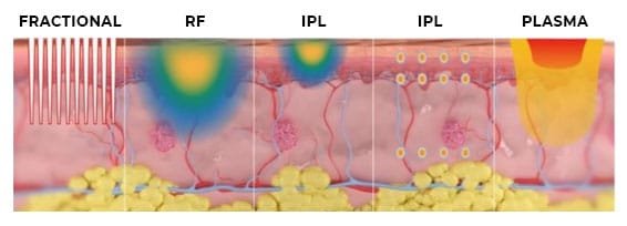 plasma treatment comparison