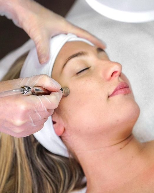 microdermabrasion